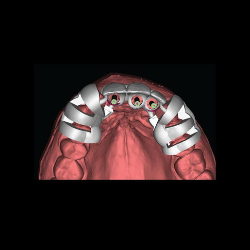 DSD Natural Restoration Temps