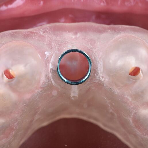 Singlepartial implant planning 1 new