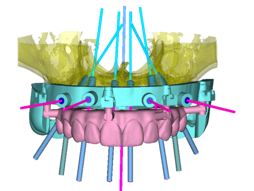 DSD Clic Guide Design