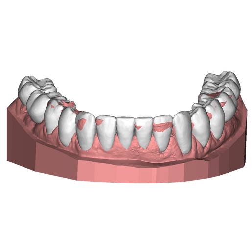 1 DSD Lower Pre treatment 1