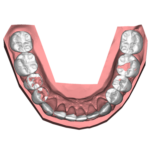 2 DSD Lower Pretreatment oclussal view