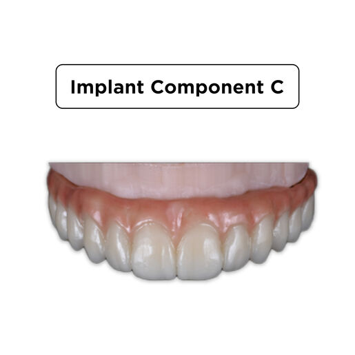 Implant Component Implant Component C