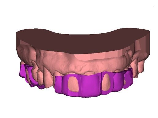 DSD Reduction Guides Design