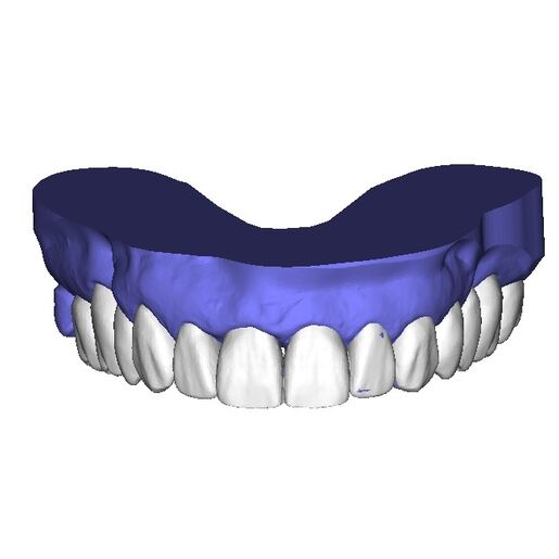 DSD Reduction Guides Design 4